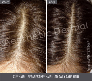 Vypadávanie vlasov, pred a po absolvovaní vlasovej mezoterapie